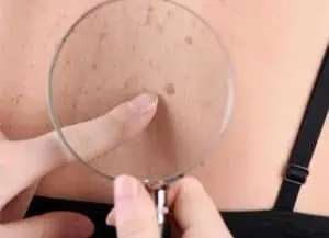 В сезона на снега и мъглите да не забравяме за рака на кожата