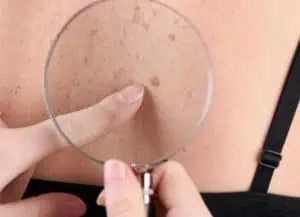 В сезона на снега и мъглите да не забравяме за рака на кожата В сезона на снега и мъглите да не забравяме за рака на кожата