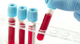 Стандартен кръвен тест предсказва риска от втори инсулт