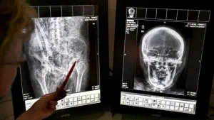 Нова техника за възстановяване на запушени артерии работи в "Света Анна"