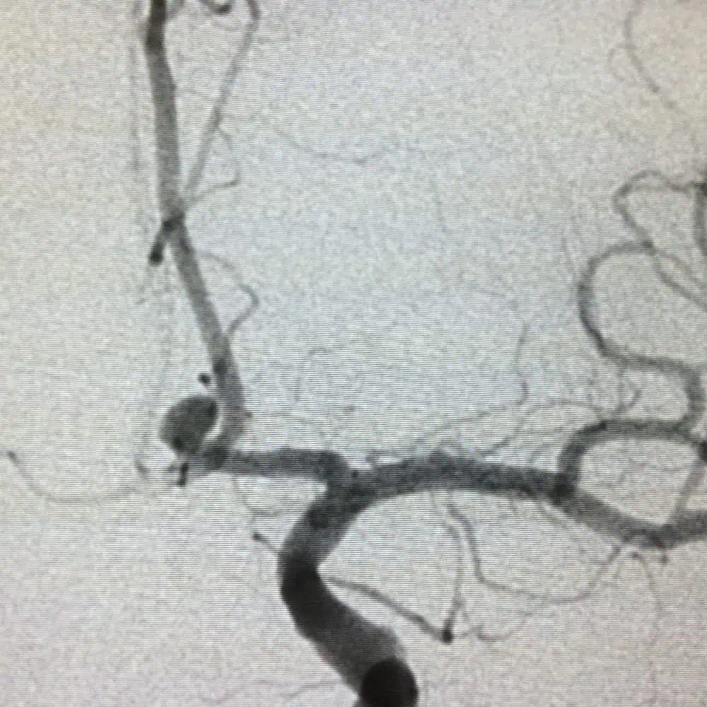 Разтварят тромби в мозъка с инжекции Разтварят тромби в мозъка с инжекции