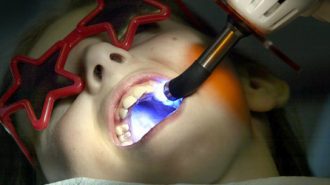 До 70 на сто намаляват кариесите след силанизиране на детските зъби