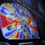 Община Бургас купува скенер за радиохирургия