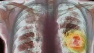 Нараства броят на злокачествените заболявания у нас