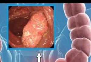 Роден специалист разкри как започва ракът на дебелото черво и какви са симптомите!