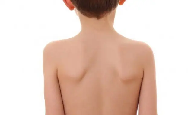 Започва кампания срещу гръбначните изкривявания при децата Започва кампания срещу гръбначните изкривявания при децата