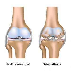 Не подценявайте остеоартрита