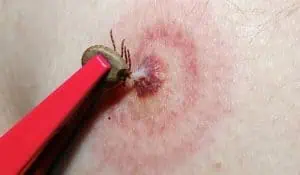 Внимание! Нападат ни кърлежи