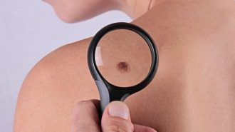 Безплатни прегледи за рак на кожата в УСБАЛО