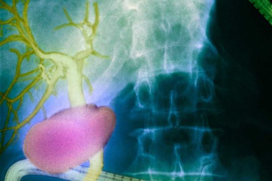 Новооткрит човешки орган може би е виновен за метастазите на рака