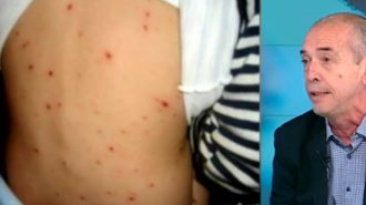 Бум на болни от варицела в България