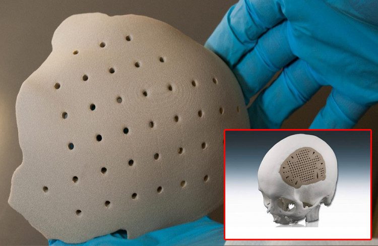 Д-р Асен Хаджиянев: 3D имплант заменя липсващи кости на черепа