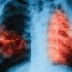 МЗ обяви безплатни прегледи за туберкулоза от 9 до 13 декември