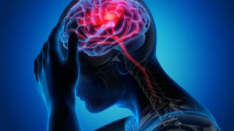 Мозъчният инсулт се случва при пристъп на мигрена