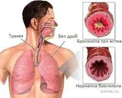 Астмата и полипите в носа често вървят заедно