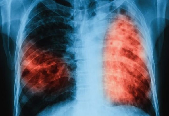 МЗ: Трайно намалява броят на болните от туберкулоза в страната