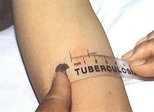 Световния ден за борба с туберкулозата